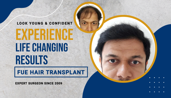 hair transplant life changing results 